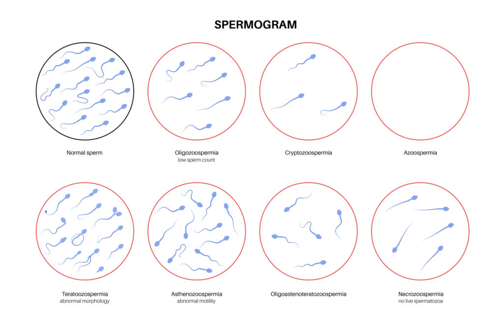 Ilustración de las afecciones del esperma como la teratozoospermia