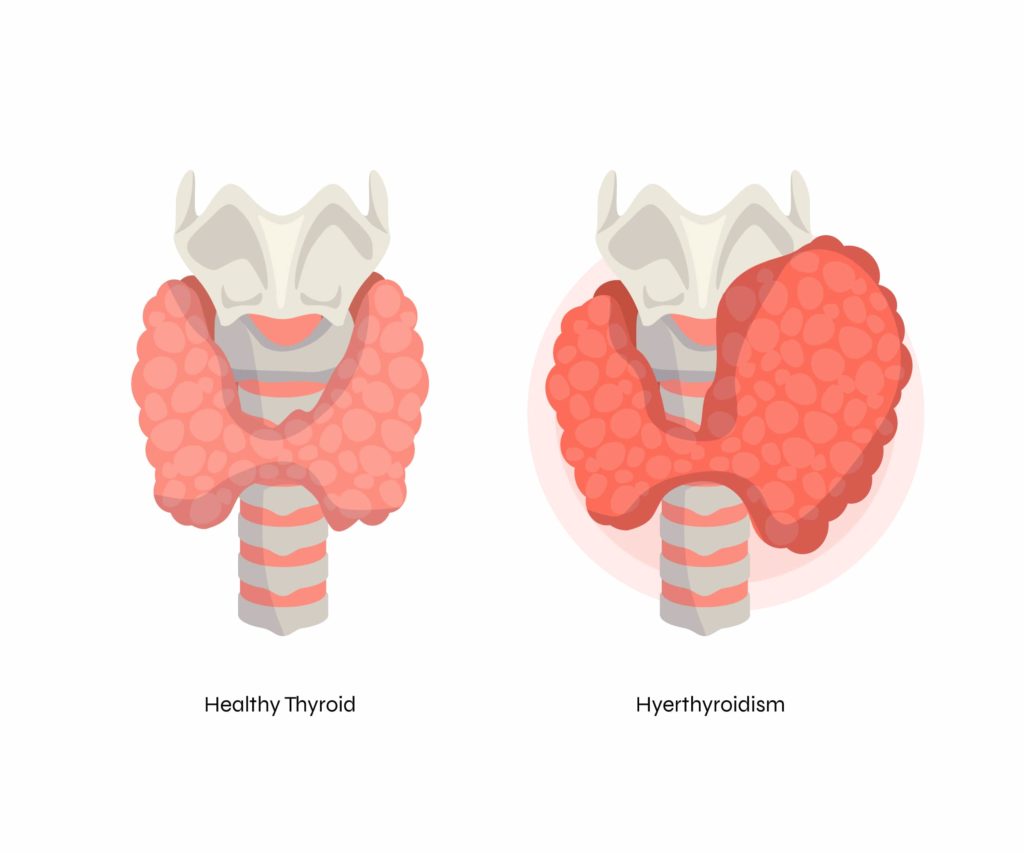 Ilustración de la glándula del tiorides para explicar la diferencia entre una normal y una con hipotiroidismo