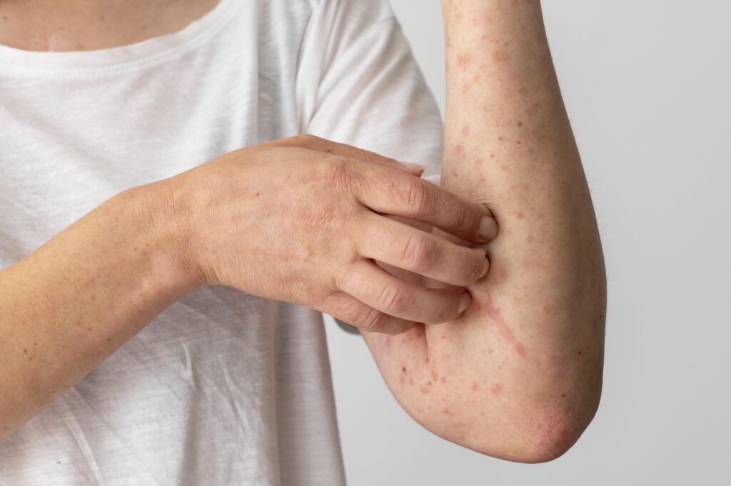 skin-allergy-reaction-person-s-arm (1)-min qué es el lupus